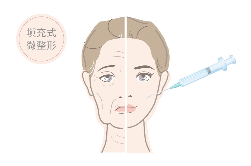 玻尿酸 功效3 填充式微整形 精雕微整