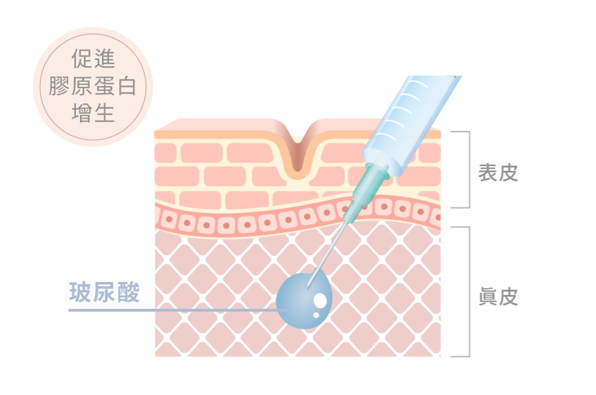 玻尿酸 功效2 促進膠原蛋白增生,抗對肌膚衰老