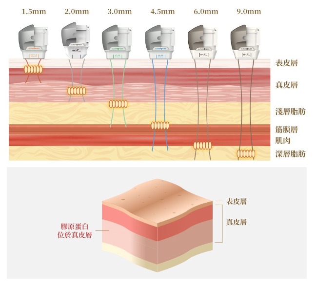 探頭深度選擇多元  可依不同部位與需求，搭配 1.5mm、2.0mm、3.0mm、4.5mm、6.0mm、9.0mm 等不同深度