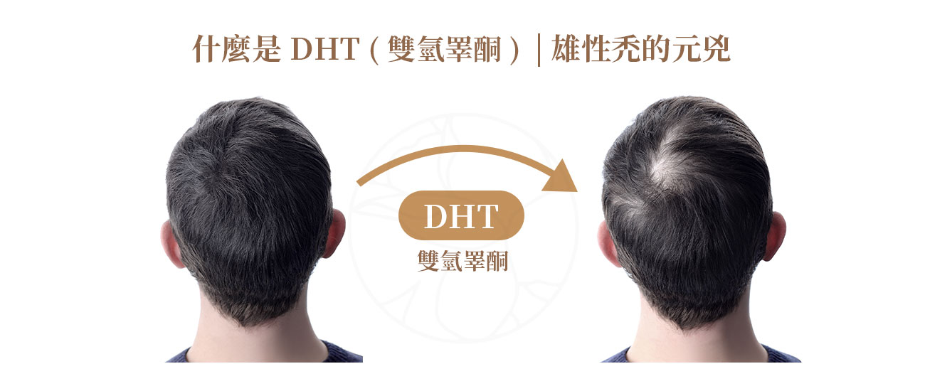 DHT 全名是 雙氫睪酮（Dihydrotestosterone），它是男性荷爾蒙「睪固酮（Testosterone）」在體內代謝後的一種產物。DHT 會與毛囊上的雄性荷爾蒙受體結合，使毛囊逐漸萎縮，生長週期縮短，頭髮變得又細又短，最後不再長出頭髮。