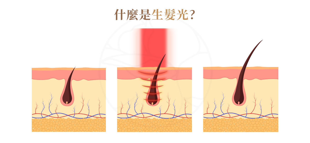 生髮光，又稱低能量雷射（Low-Level Laser Therapy, LLLT），是一種非侵入性、無痛感的自然生髮方式。透過低能量雷射光照射深入頭皮底層，刺激毛囊細胞粒線體，提升細胞能量（ATP）生成，進而 促進頭皮血液循環、延長毛囊生長期、活化休止期毛囊。