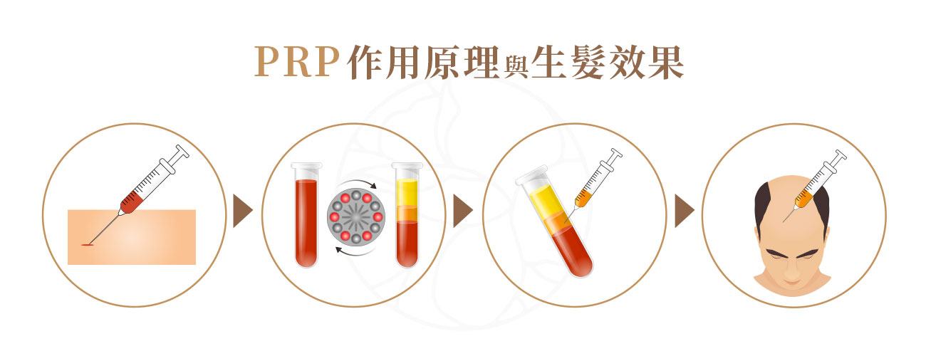1.專屬萃取，從治療對象身上抽取少量血液。2.過專業離心技術，將血液中的紅血球與白血球分離，只保留中間層，富含高濃度血小板的血漿 3.精準導入  專業醫師會使用極細的針頭，將 PRP 精準地注射到需要改善的頭皮區域 4.啟動再生  注入頭皮的血小板會立即被活化，瞬間釋放出大量的生長因子。