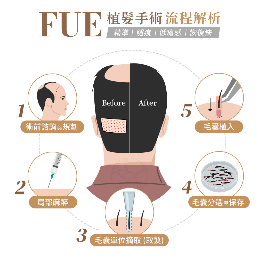 1. 術前諮詢與規劃 在手術開始前，醫師會先進行詳細的面對面諮詢與頭皮評估。 2. 局部麻醉 正式手術前，醫師會在「供髮區」與「植髮區」施打局部麻醉。 3. 毛囊單位摘取（取髮） 醫師使用口徑極小的 微型鑽孔器（Punch Tool），逐一精準地鑽取毛囊單位。 4. 毛囊分選與保存 取出的毛囊會立即放入專用保存液中，在高倍顯微鏡下進行細心分選。 5. 毛囊植入 這是手術時，最需要專注及精準度的步驟。 在植髮區根據預先規劃的髮流方向、角度與密度，利用微小刀具或植髮筆（Implanter Pen）製造出微小的切口或通道。 隨後，將分選好的毛囊單位逐一小心翼翼地植入這些預定的位置。