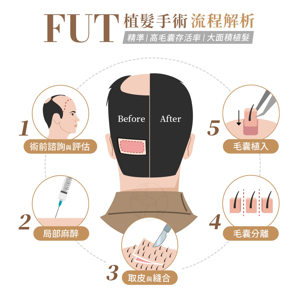 1. 術前評估: 先進行完整的頭皮檢查與落髮分級 2. 局部麻醉: 在正式取髮前，醫師會先在後枕部與植入區域進行局部麻醉。3. 取皮與縫合: 枕部劃下一條約 1～2 公分寬的帶狀頭皮組織。 取皮後會以可吸收縫線精細縫合。4. 毛囊分離:取下的頭皮組織會立即交由毛囊分離師處理。5. 美學設計與植入: 植髮醫師會依據髮友的臉型比例、原生髮流向與密度設計植入區域。