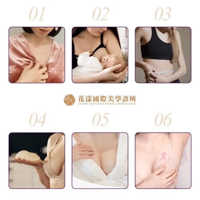 魔滴 2.0 JOY 絕世好波適合誰 1. 上胸無肉,追求豐滿的乳溝效果。 2. 產後媽媽,改善懷孕或哺乳的乳房變形困擾。 3. 體重大幅減輕導致乳房萎縮者。 4. 重視隆乳安全性及穩定度。 5. 追求真實觸感,想要接近自然脂肪組織的觸感。 6. 二次隆乳/乳房重建者。