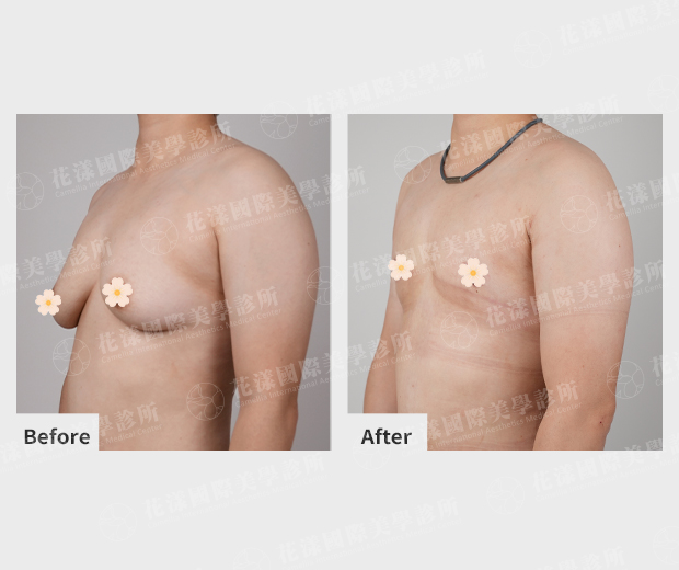 ALL_catalog_plasticsurgery_25I19_CdCExiHEsm 平胸手術成功案例