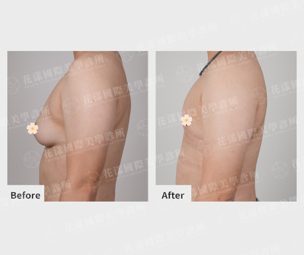 ALL_catalog_plasticsurgery_25I19_ESGfeQJTmn 平胸手術成功案例