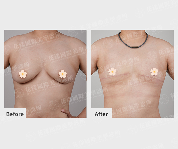 ALL_catalog_plasticsurgery_25I19_TJRRShFbxm 平胸手術成功案例