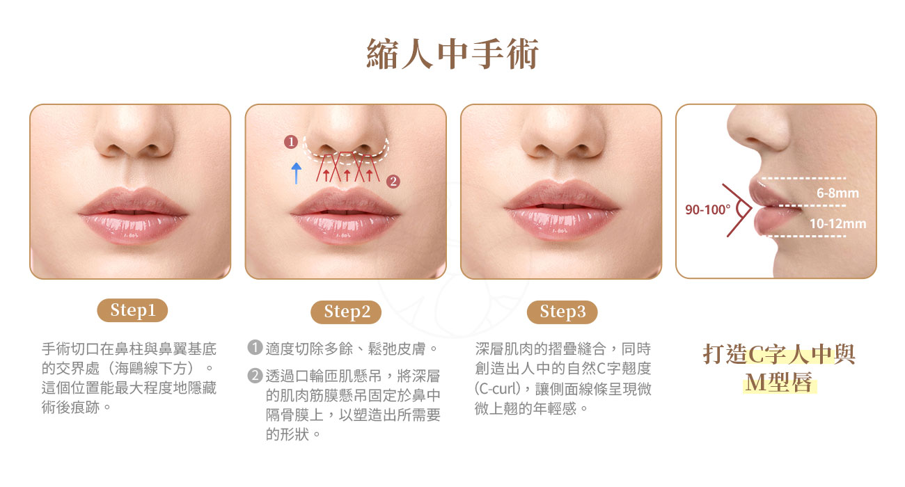 縮人中手術如何進行? 縮人中手術如何進行:1. 手術切口設計:隱痕的關鍵2. 複合式處理:不只修皮,更要肌肉懸吊3. 打造「C字人中」與「M型唇」