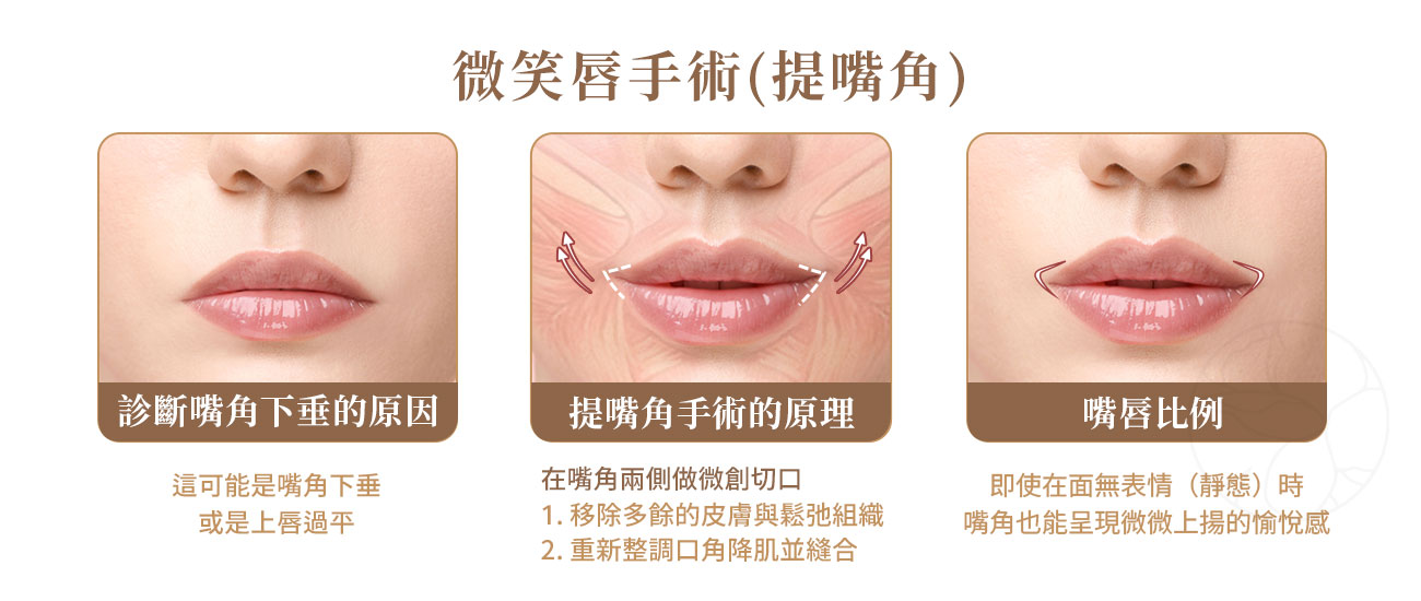 微笑唇手術原理:1.確認嘴角下垂原因2.在嘴角兩側做微創切口,客製嘴角角度3.打造最適嘴唇比例