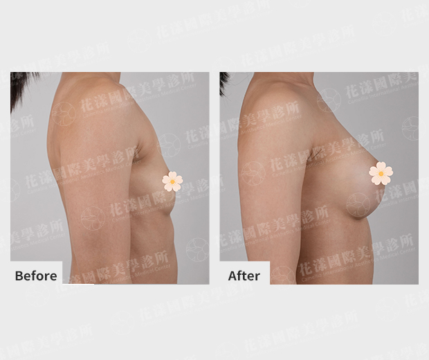 隆乳案例 側面 隆乳前後案例 側面