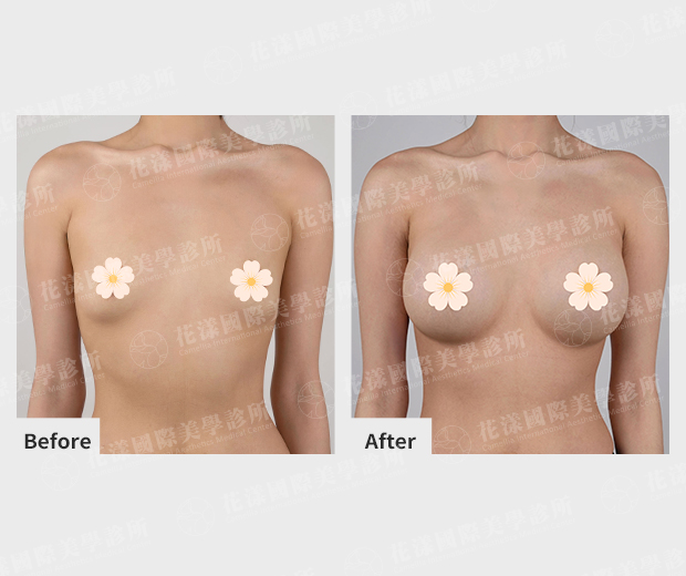 平胸隆乳案例 正面 平胸隆乳案例 正面