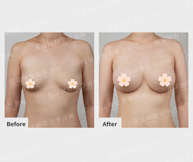 隆胸案例對照 正面 隆胸案例對照 正面