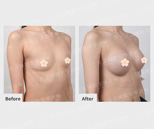 隆乳前後案例 側面 隆乳前後案例 側面