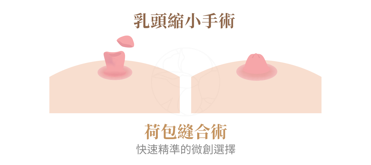 荷包縫合術：快速精準的微創選擇