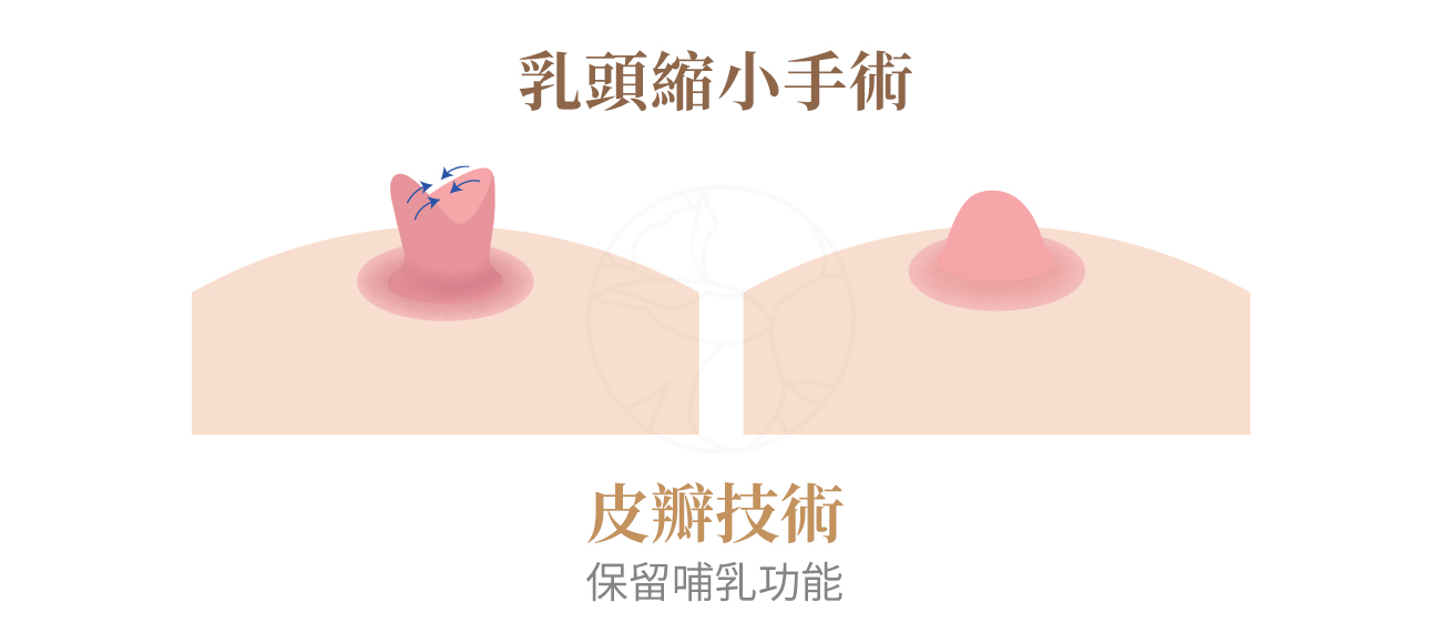 皮瓣技術：保留哺乳功能