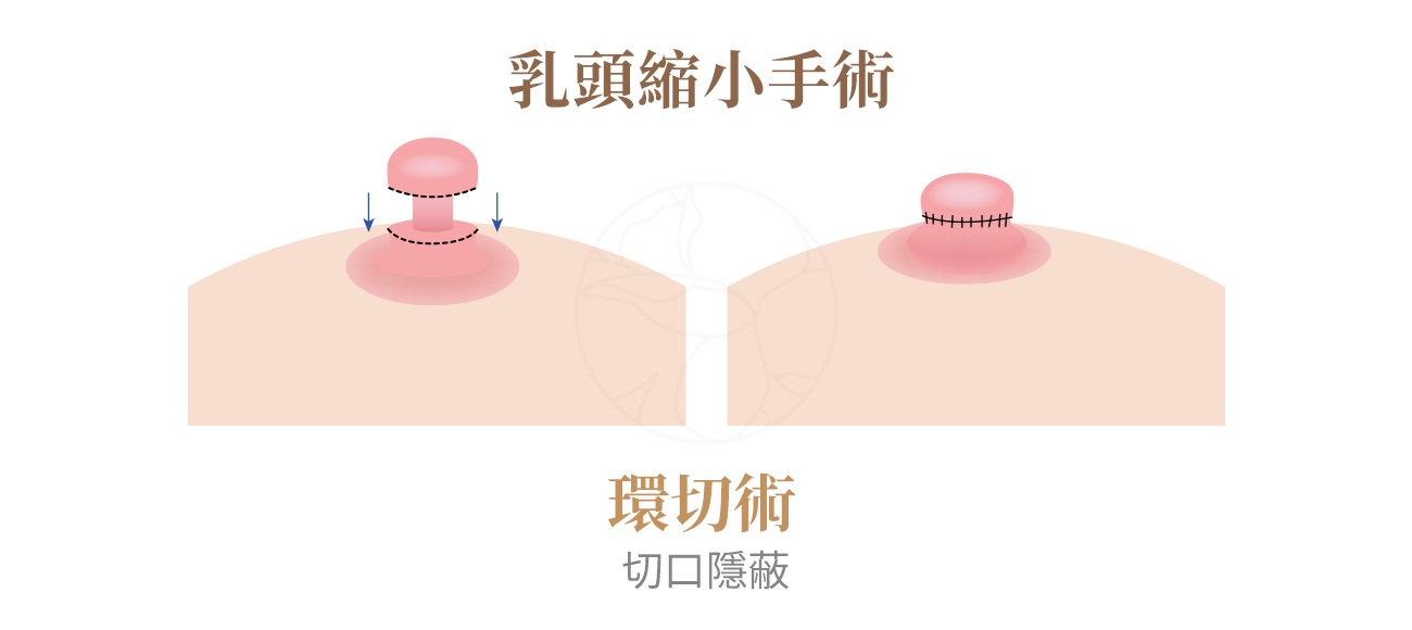 環切術：切口最隱蔽的基本款