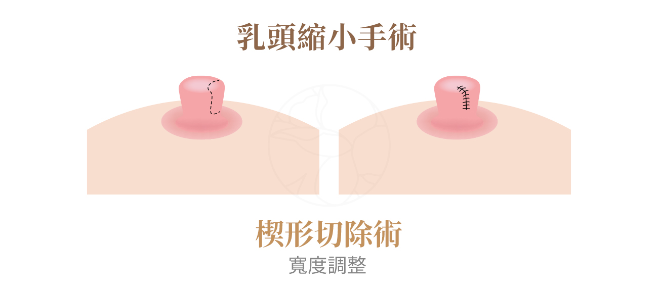 楔形切除術：長度寬度都能縮