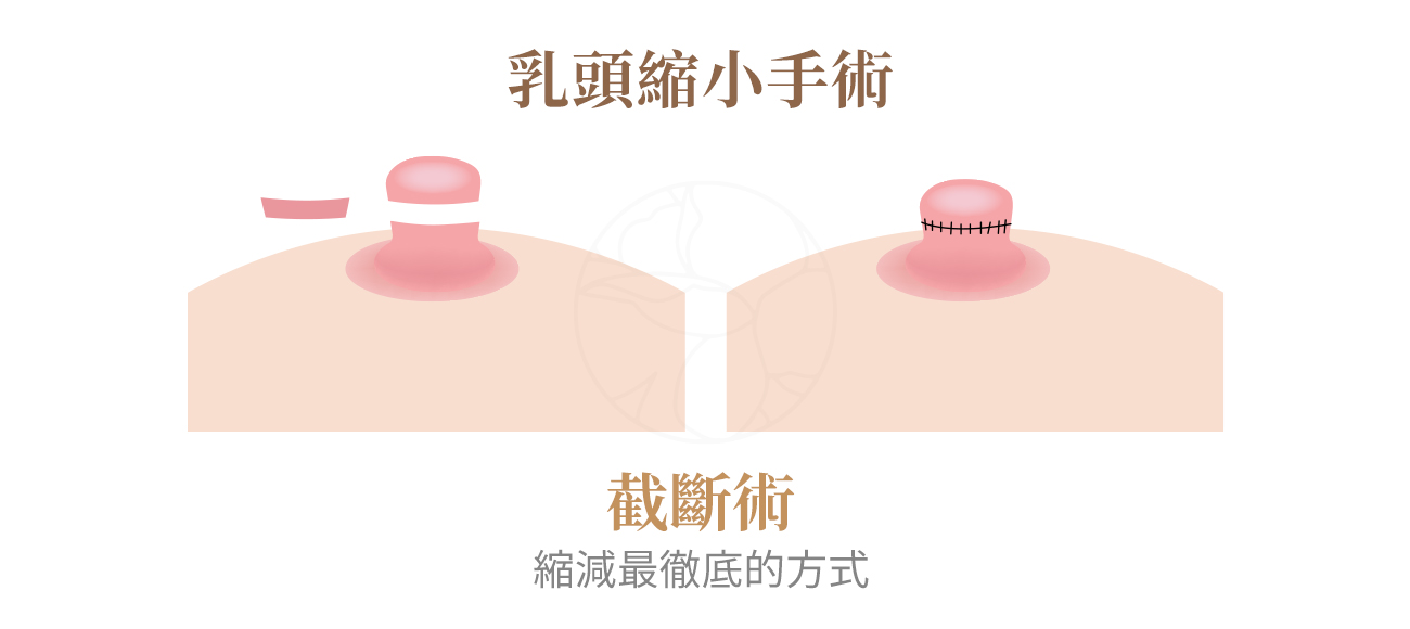 截斷術：縮減最徹底的方式