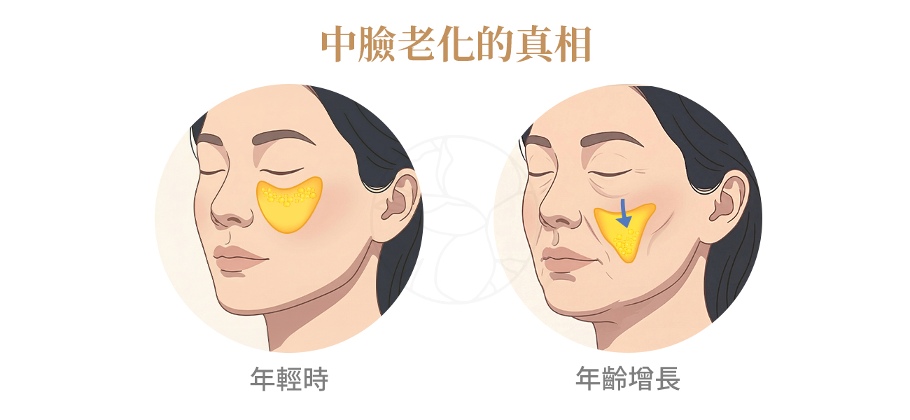 臉部老化是一個由深到淺的多層次結構崩塌過程，涉及骨骼吸收、韌帶鬆弛、脂肪位移，以及SMAS筋膜層的下垂等相互作用。  其中，影響中臉老化最關鍵的角色，是蘋果肌脂肪墊（Malar Fat Pad）。