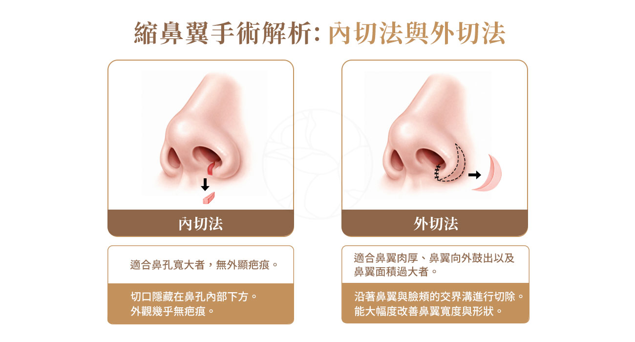 縮鼻翼手術 (Alar Reduction) 解析：內切、外切與疤痕隱藏