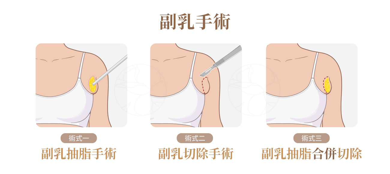 術式一：副乳抽脂術，術式二：副乳切除術，術式三（最常用）：副乳抽脂合併切除