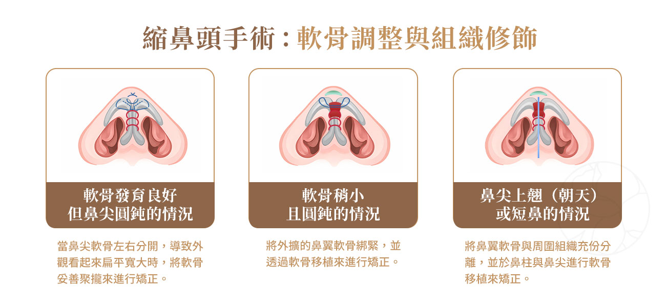 縮鼻頭手術 (Nasal Tip Plasty) 核心解析：軟骨調整與組織修飾
