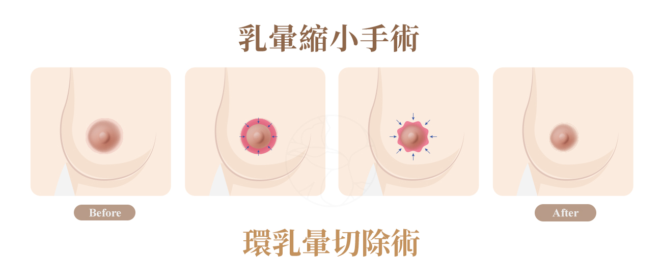乳暈縮小手術主要術式詳1.環乳暈切除術2. 經皮荷包縫合術3. SPAIR 乳房縮小術4. 向心荷包縫合重建術