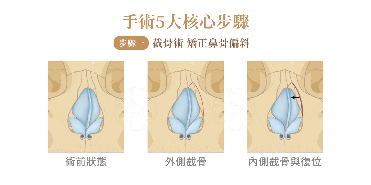 截骨術（Osteotomy）：矯正鼻骨偏斜的核心手術