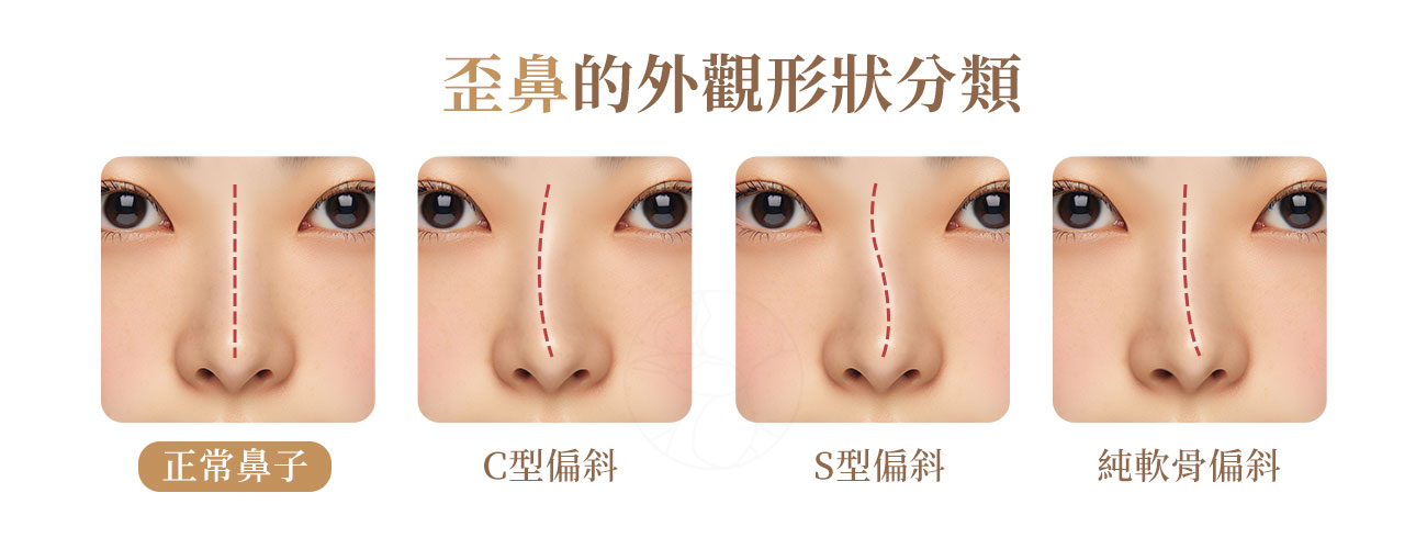 鼻子歪斜是什麼? C型偏斜、S型偏斜、純軟骨偏斜