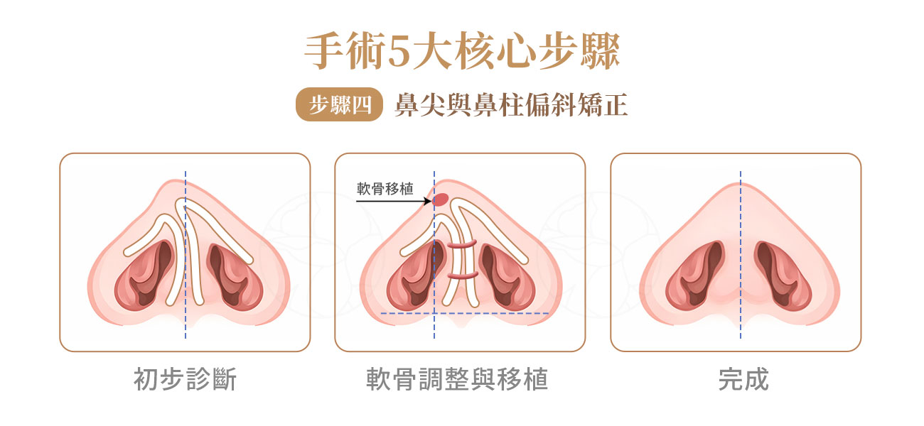 鼻尖移植物與對稱重建