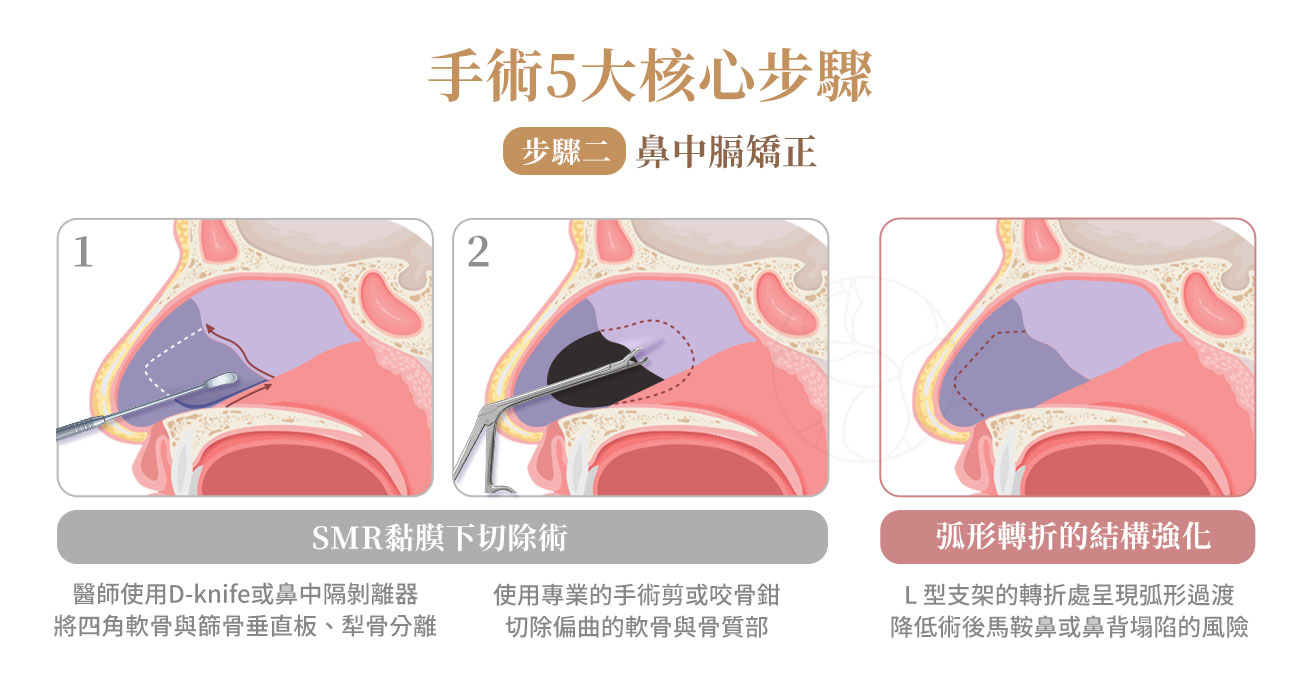 鼻中膈矯正