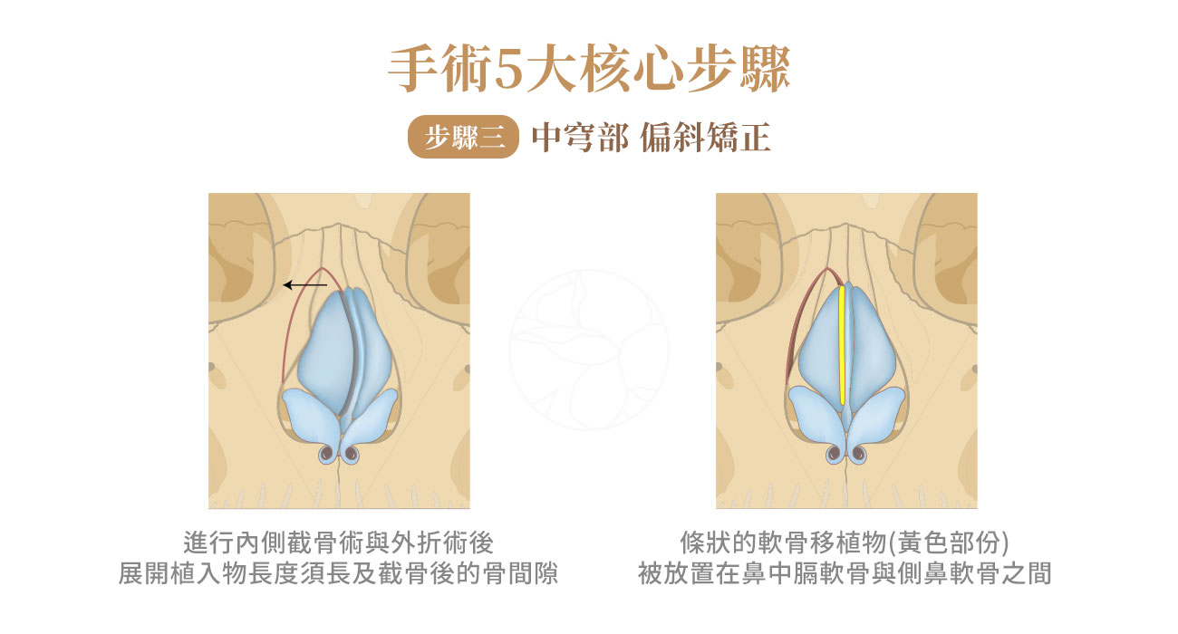 中穹部 偏斜矯正