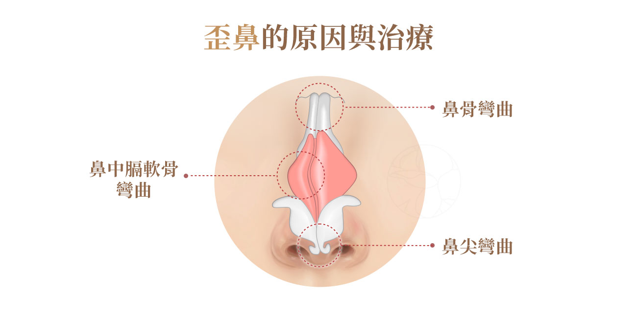 歪鼻原因: 鼻骨彎曲、鼻尖彎曲、鼻中隔彎曲