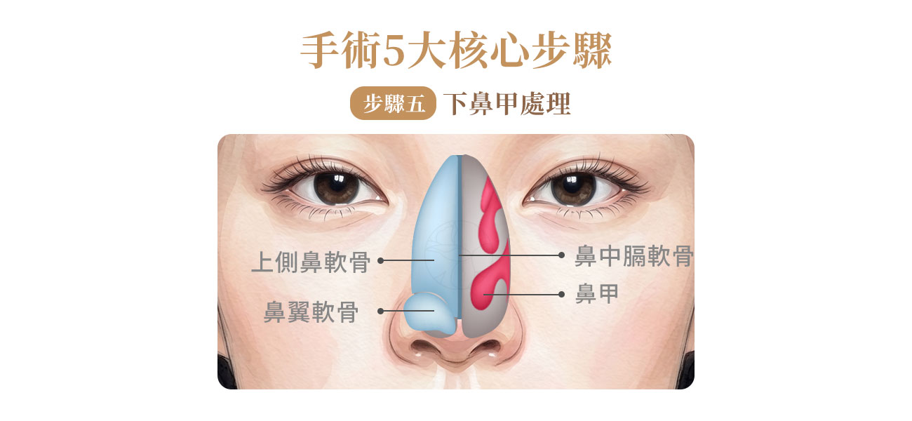 下鼻甲肥大的處理（Inferior Turbinate Manipulation）