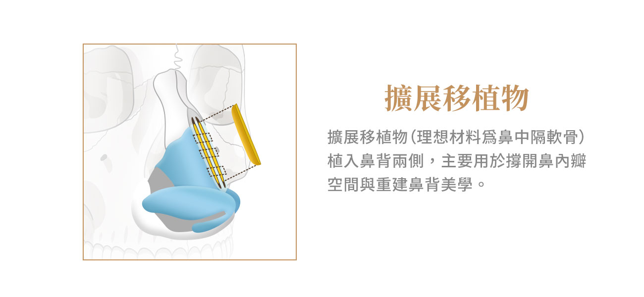擴展移植物: 主要用於撐開鼻內瓣空間與重建鼻背美學