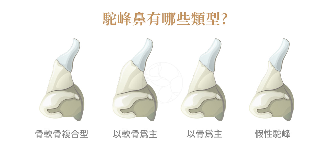 駝峰鼻有哪些類型的四種型態：骨軟骨複合型（最常見）、以軟骨為主型、以骨為主型（最少見）、假性駝峰