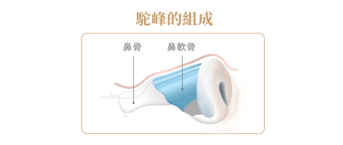 駝峰鼻的結構組成是由骨性駝峰與軟骨性駝峰
