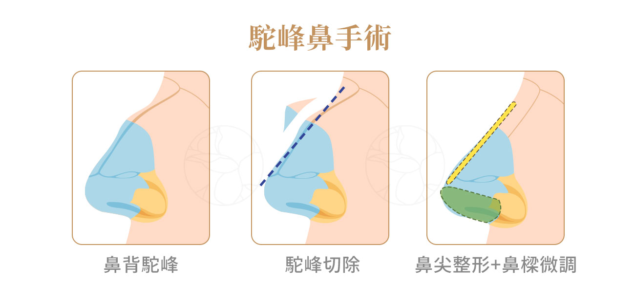 駝峰鼻手術3大核心: (1)駝峰縮小（Hump Reduction）、(2)截骨術（Osteotomy）(3)鼻尖整形（Tip Plasty）。