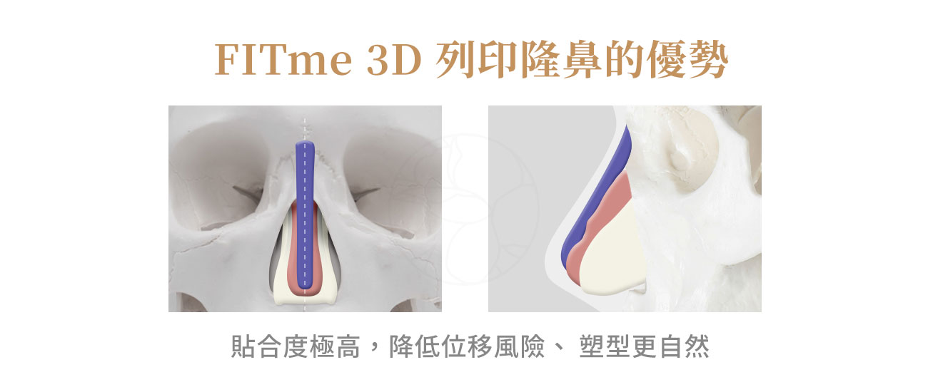 FITme隆鼻優勢: 貼合度高、降低位移風險、塑型更自然
