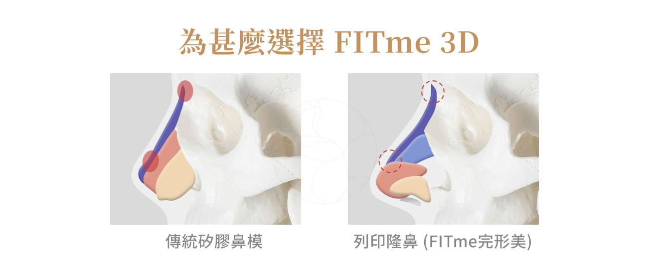 傳統矽膠鼻模是統一規格的成品，醫師必須依經驗在手術當下修剪雕刻；而 FITme 則是先透過電腦斷層掃描（CT / CBCT）取得患者真實骨相數據，再由醫師與 FITme 原廠工程師共同設計，最後以 3D 列印技術製作出完全為個人量身訂製的鼻模，精密度可達&nbsp;0.07 mm 等級。