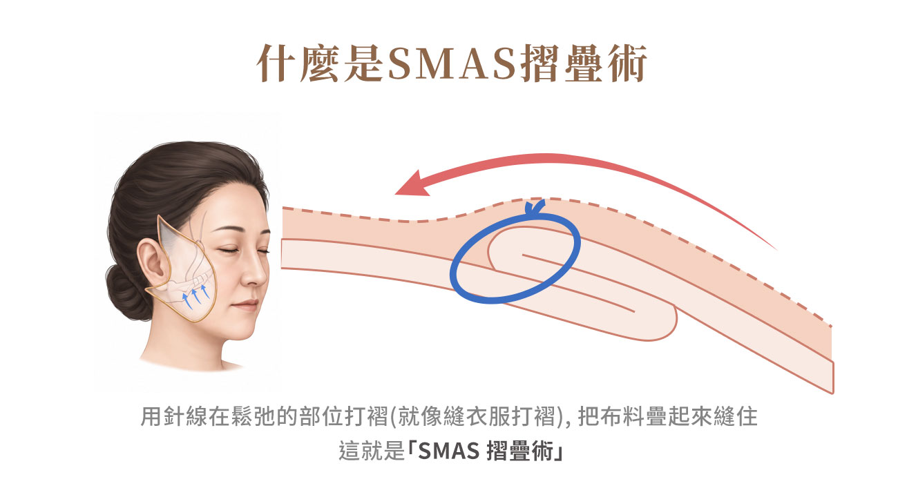 在鬆弛的部位打褶，把組織疊起來並縫住&rarr; 這就是「SMAS 摺疊術（SMAS Plication）」