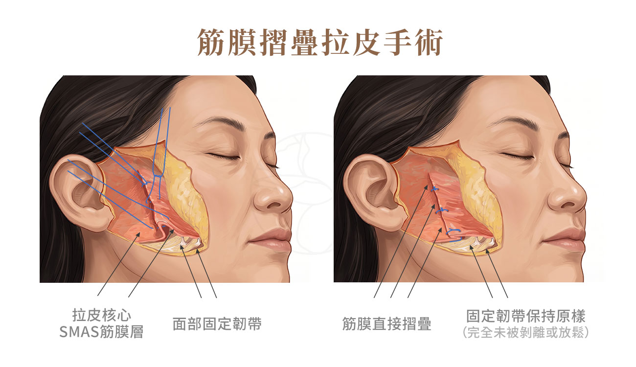 拉皮的核心為SMAS筋膜層，將筋膜直接摺疊縫合並固定韌帶保持原樣