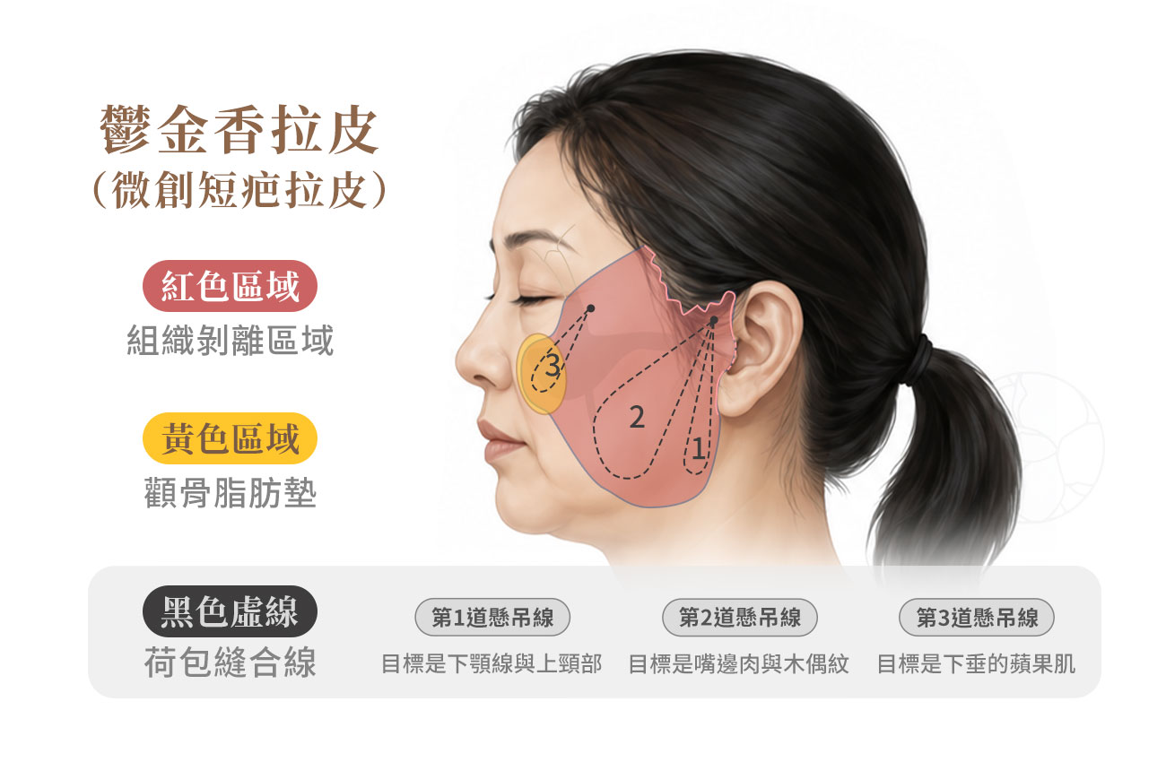 圖中紅色區域為組織剝離區域，黃色區域為顴骨脂肪墊，黑色虛線為荷包縫合線。