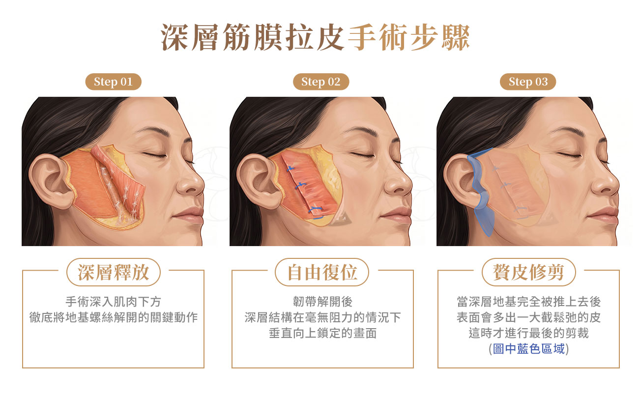 深層筋膜拉皮手術步驟: 1.深層釋放, 手術深入肌肉下方, 2.深層結構垂直向上鎖定 3.贅皮修剪