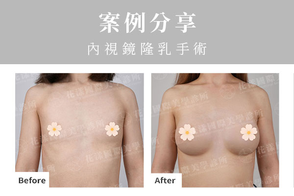 內視鏡隆乳術前術後對比圖，呈現自然胸型與腋下隱痕效果