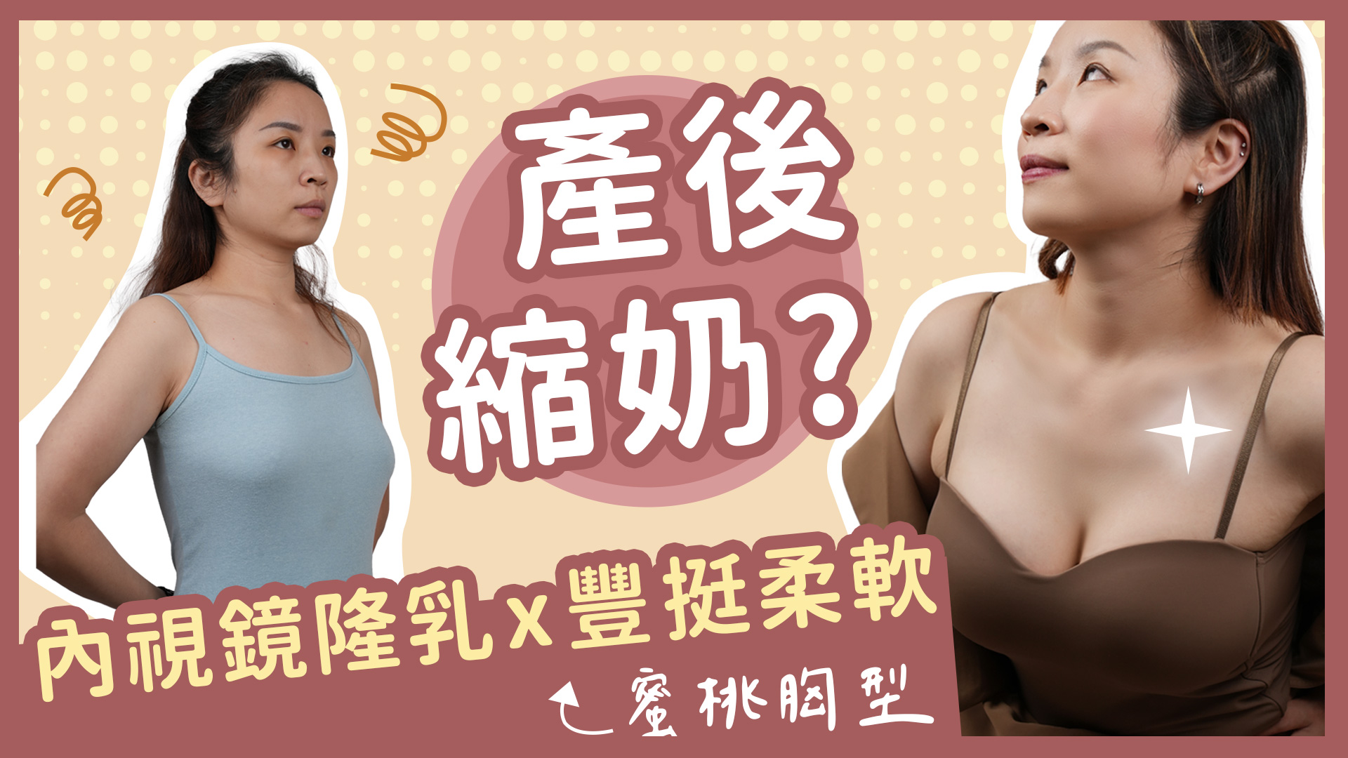  產後縮奶?｜珍珠波內視鏡隆乳 x 蜜桃般柔軟飽滿｜隆乳手術案例｜feat 整形外科 錢逸群醫師