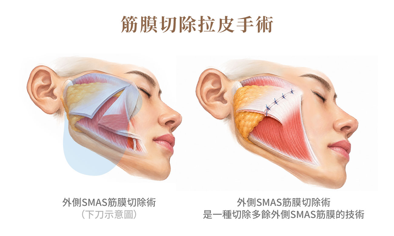 筋膜切除拉皮手術 左圖及右圖顯示,筋膜切除拉皮手術是一種切除多餘外側SMAS筋膜的技術
