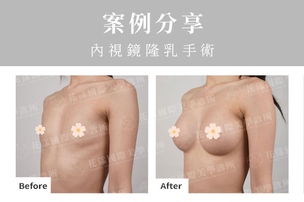 天生小胸部，經錢醫師評估後，實現自然C奶的自然胸型