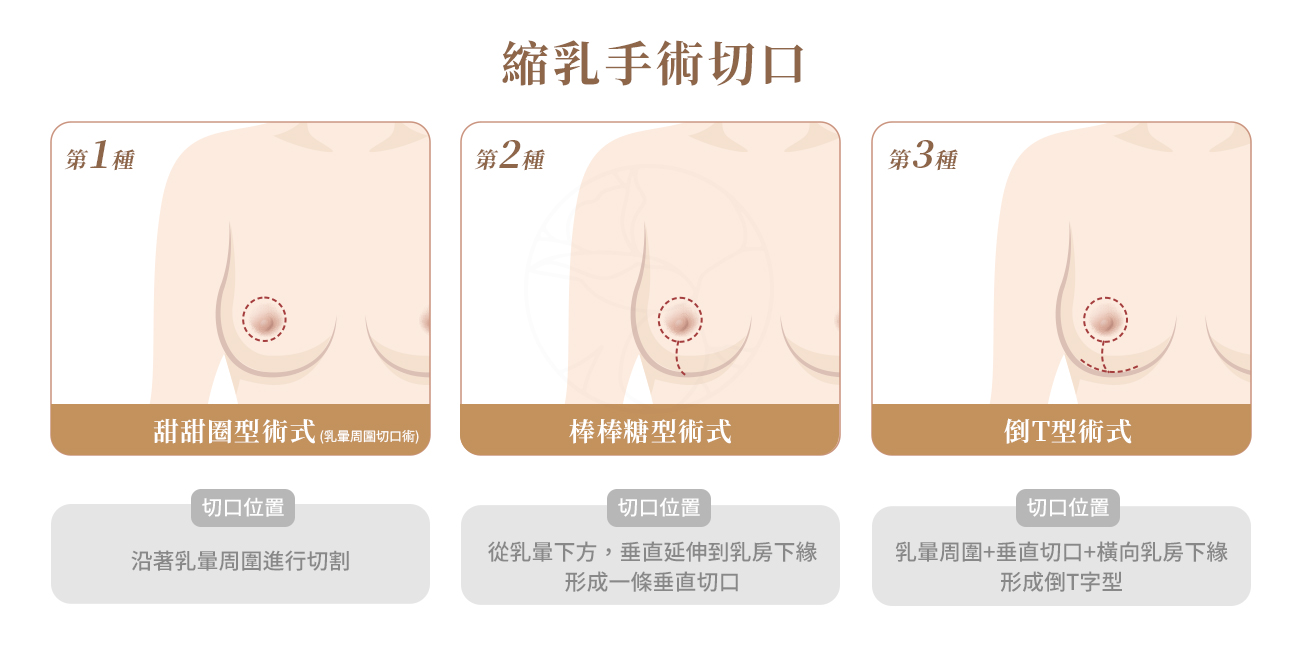 縮乳手術3種切口：乳暈環切(甜甜圈)、垂直疤/棒棒糖(短疤)、倒T/錨形